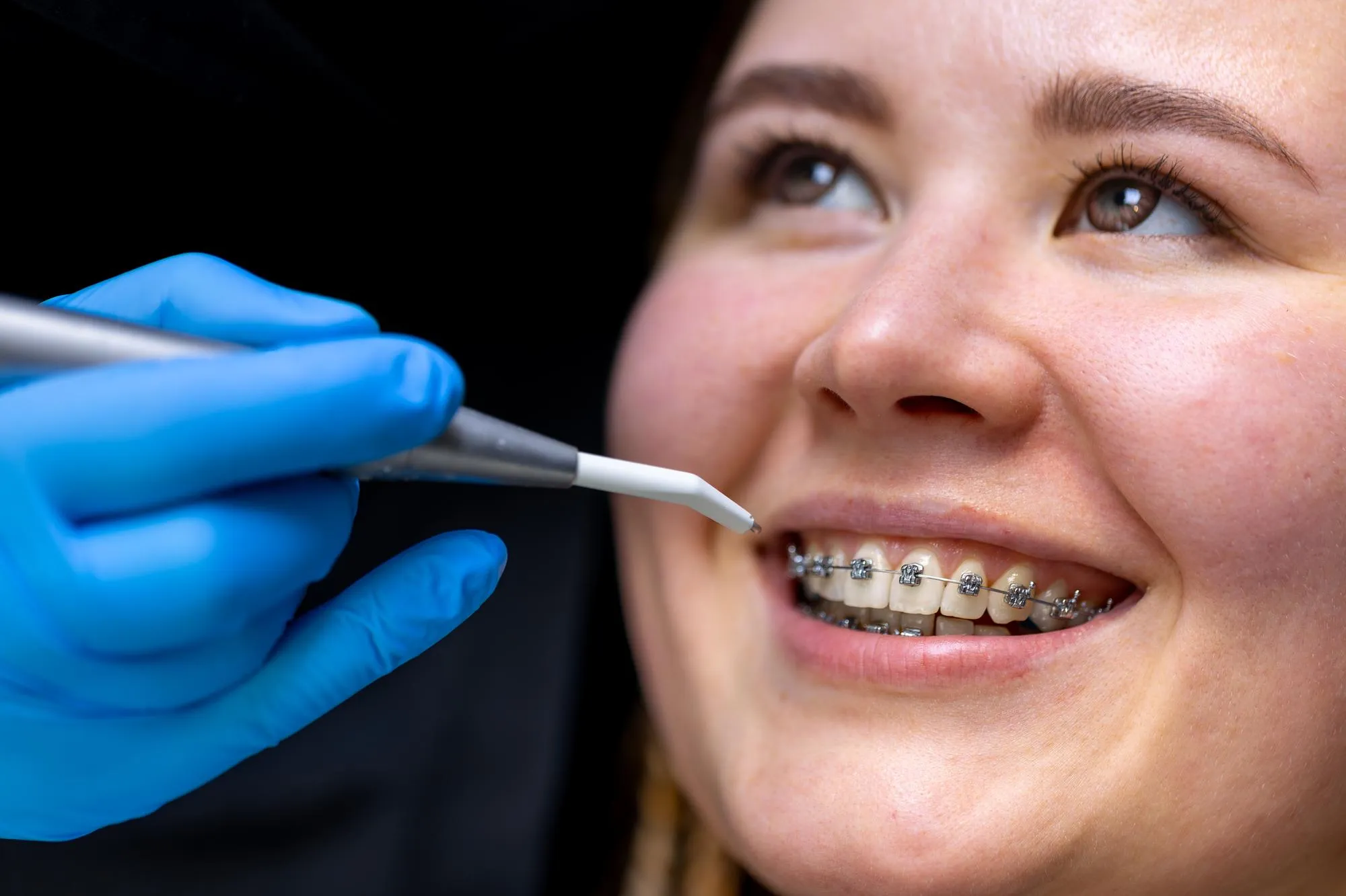 Ceramic Braces Discreet Path To A Confident Smile