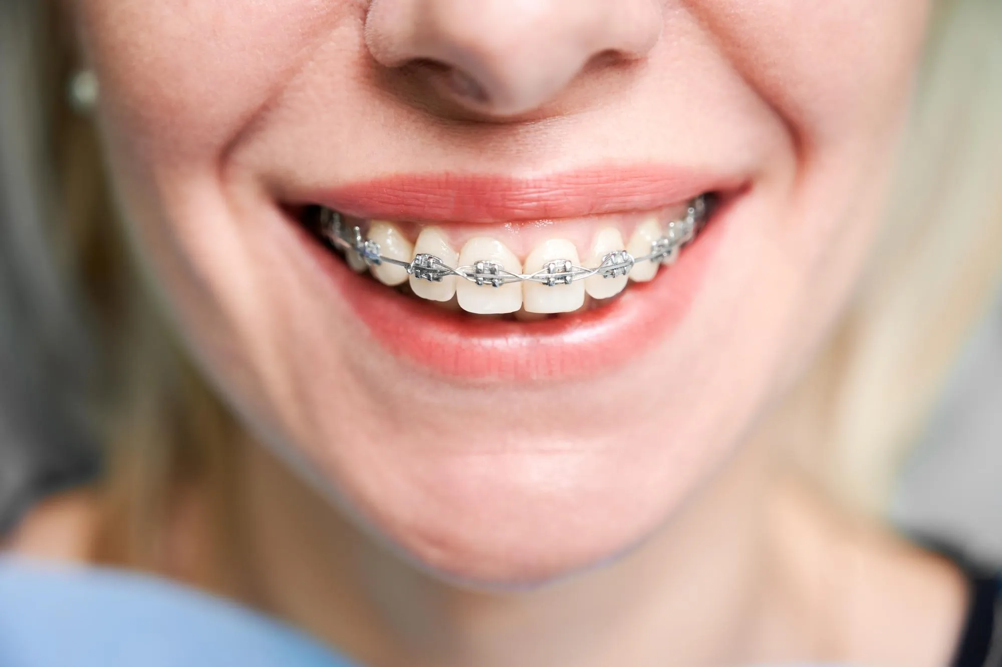 How Ceramic Braces Help You Achieve a Straighter Smile