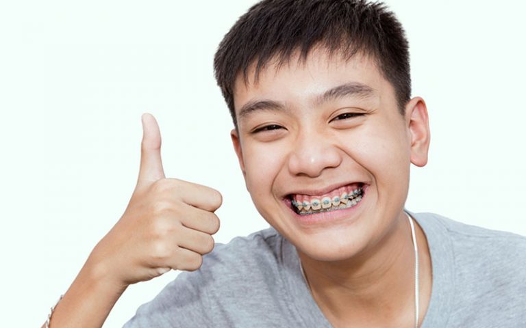 Ceramic Braces Near You