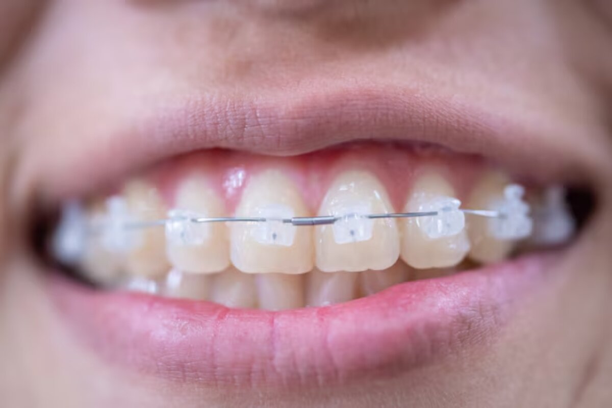 Why Ceramic Braces Are a Popular Choice for Image-Conscious Patients