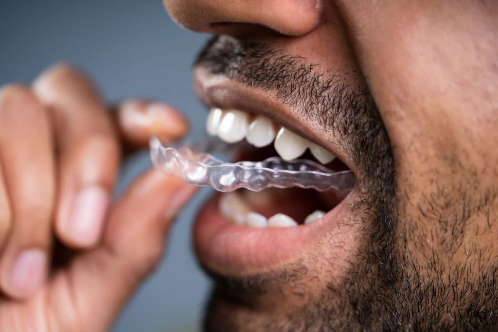 how to clean and care for your retainer