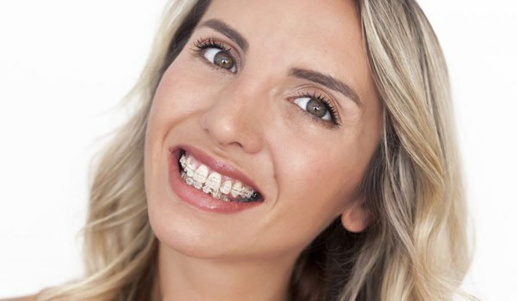which is right option for your teeth ceramic or metal braces