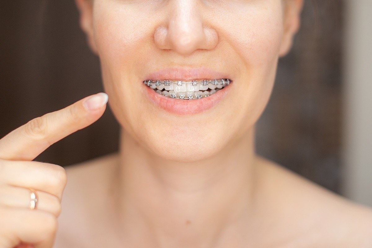 your path to dental wellness with adult braces