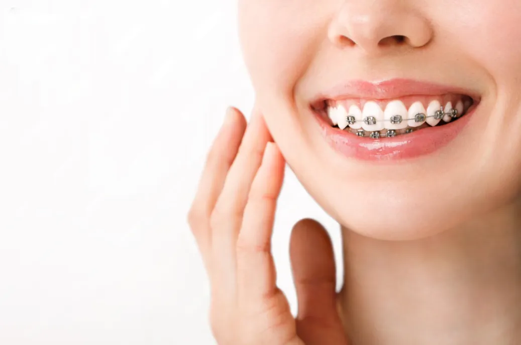 braces care types of braces