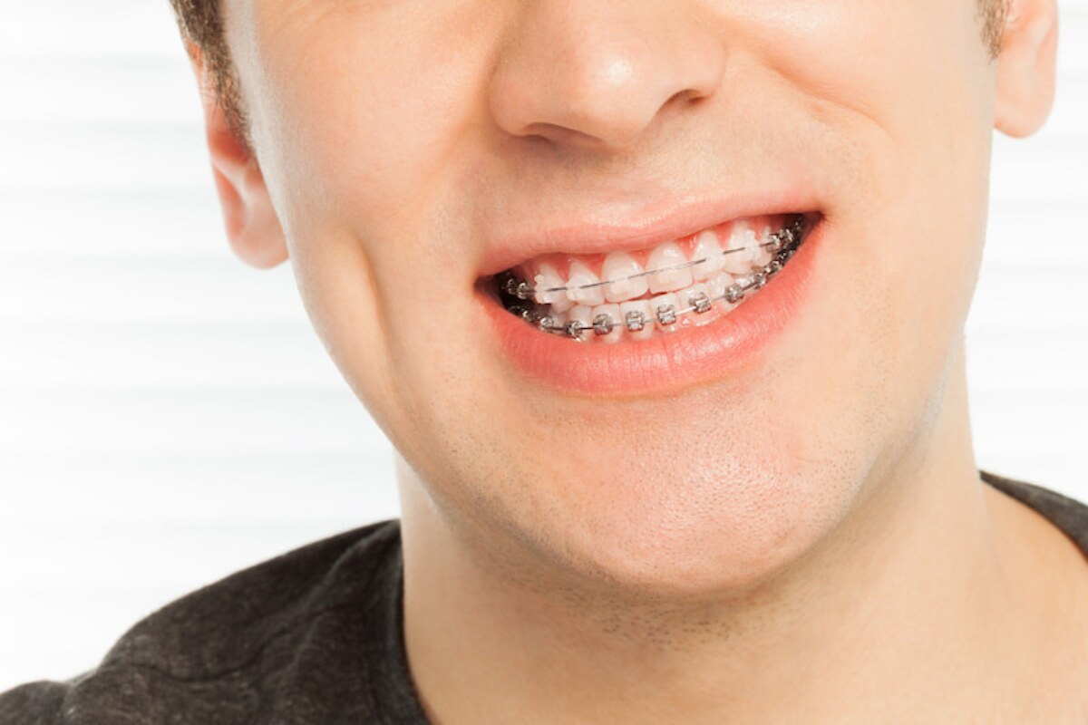 ceramic braces vs metal braces which is right for you