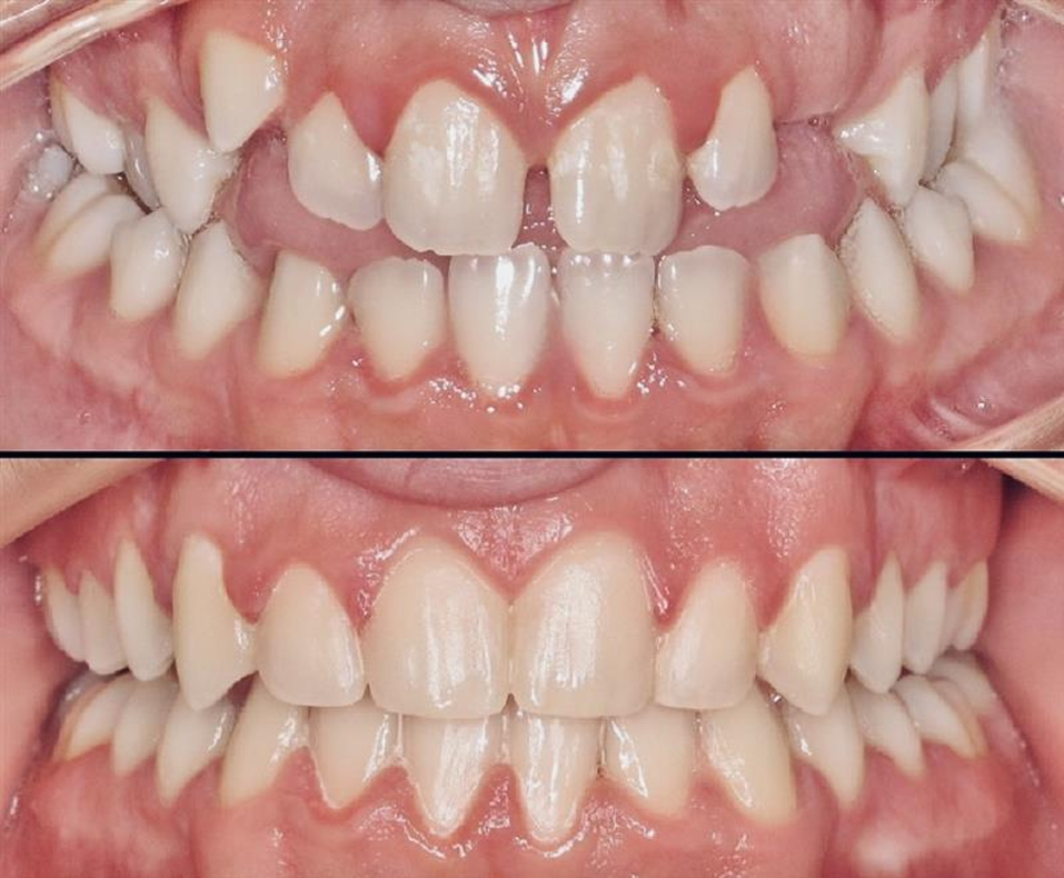 Orthodontic Treatment for Crossbite