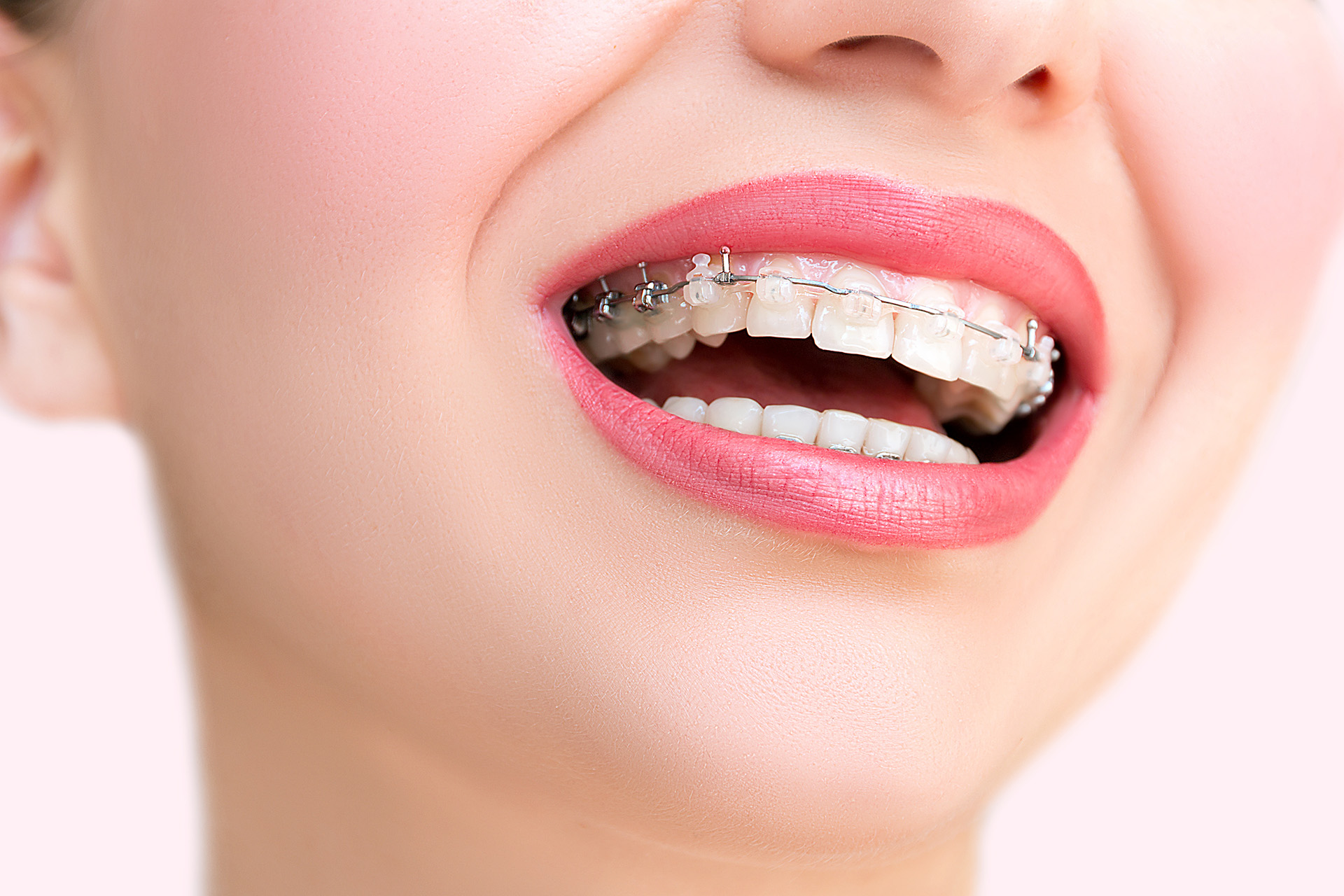 Ceramic Braces