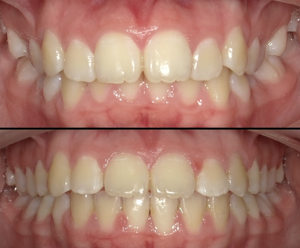 Orthodontic Treatment for Deepbite