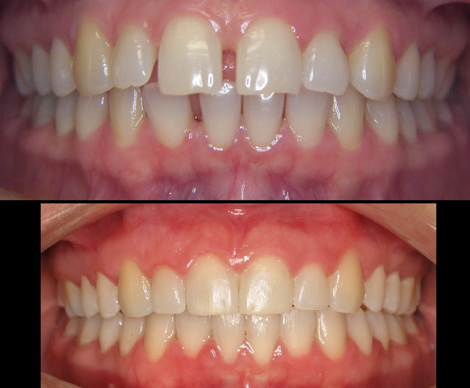 Orthodontic Treatment for Diastema