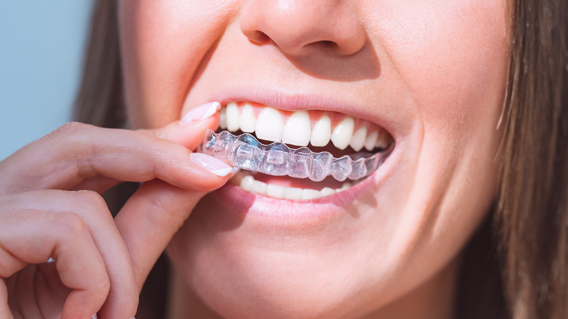 Invisalign Treatment Process