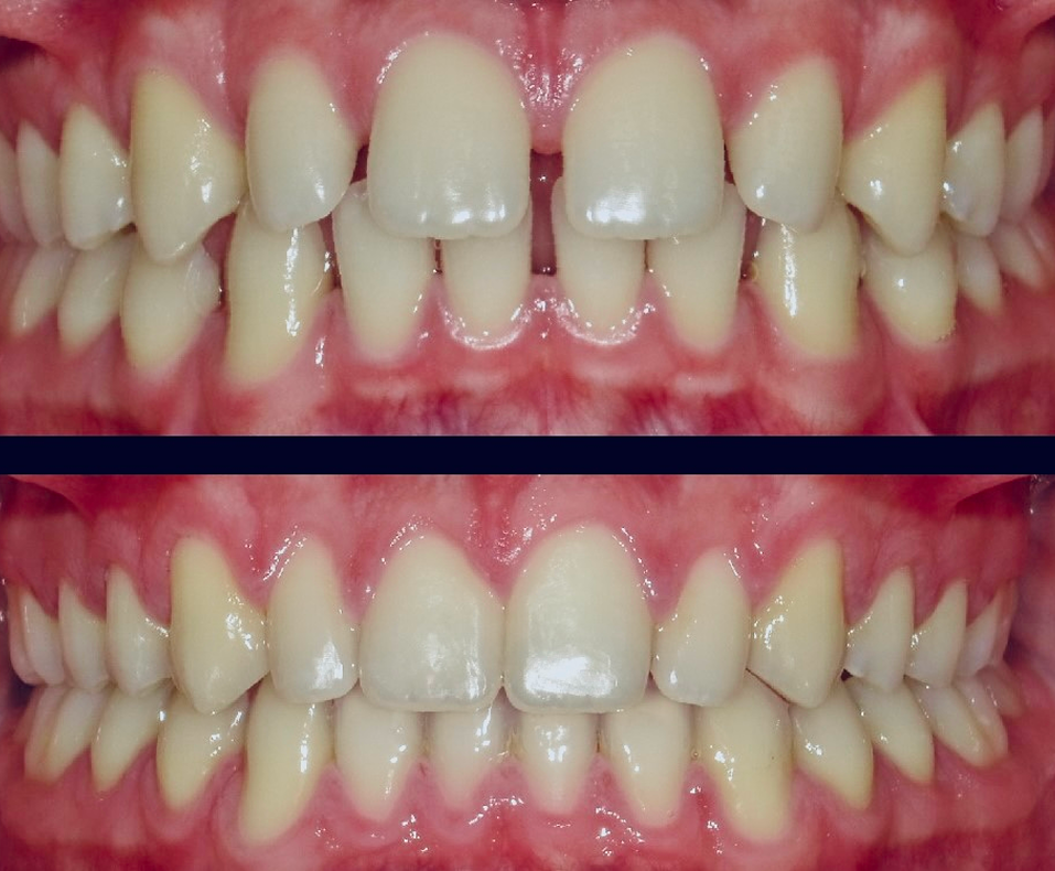 Orthodontic Treatment for Spacing