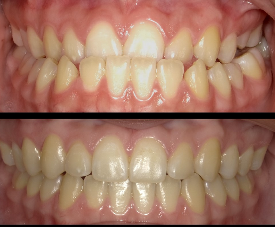 Orthodontic Treatment for Underbite