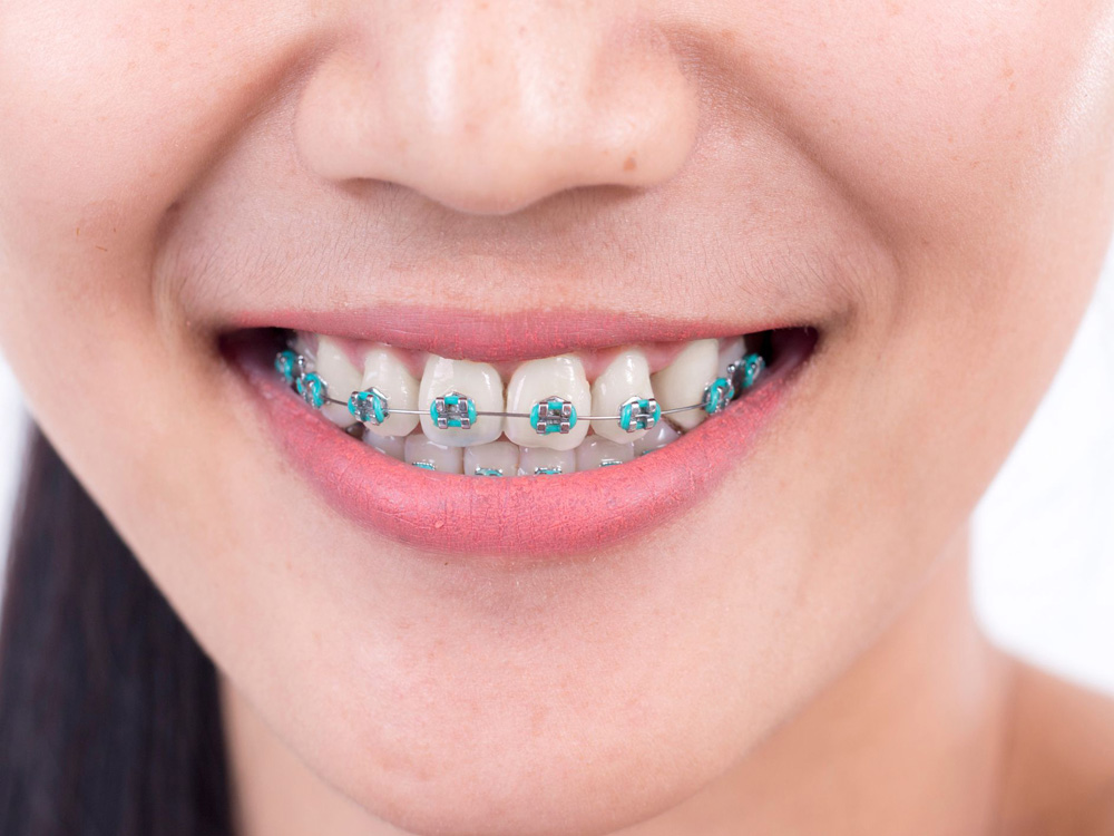 Metal Braces