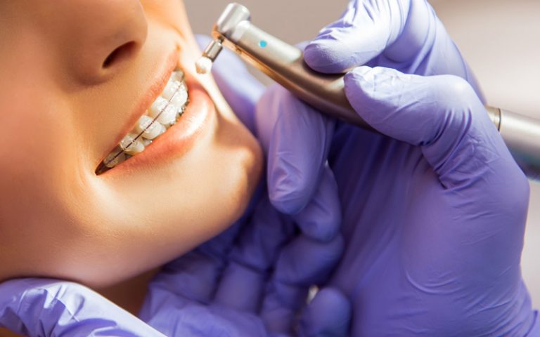 Ceramic Braces in Orlando Florida