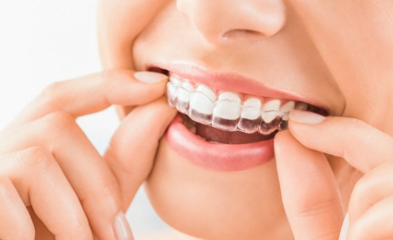 Essix Retainer in Orlando, Florida
