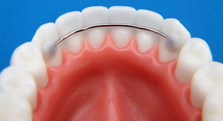 Bonded Lingual Retainer