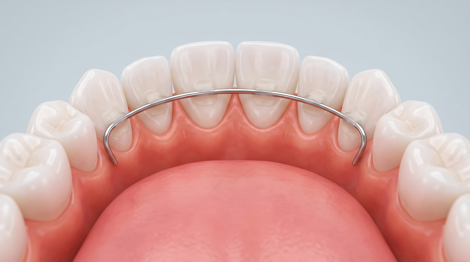 permanent lingual retainer